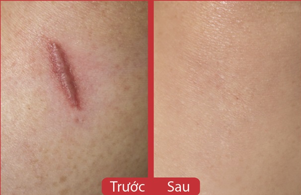Kết quả sau 8 tuần trị sẹo lồi bằng Scarguard 30ml